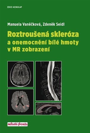 Roztroušená skleróza a onemocnění bílé hmoty v MR zobrazení - Zdeněk Seidl,Manuela Vaněčková