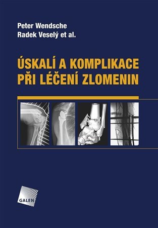 Úskalí a komplikace při léčení zlomenin - Peter Wendsche,Radek Veselý