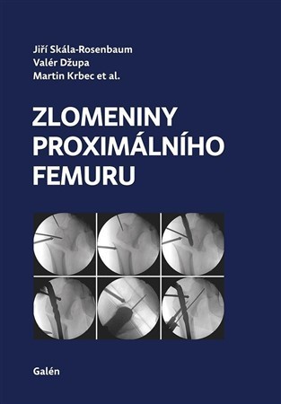 Zlomeniny proximálního femuru kúpite na Panta Rhei