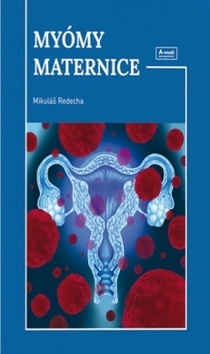 Myómy maternice - Mikuláš Redecha