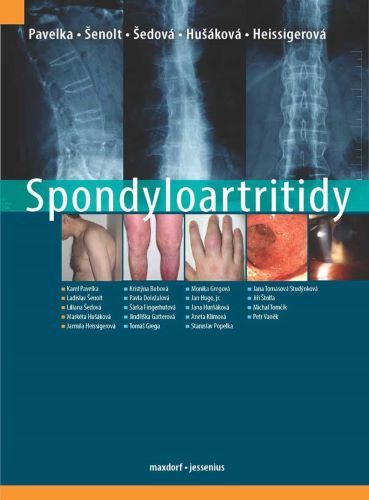 Kniha Spondyloartritidy