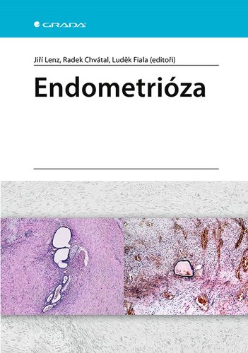 Kniha Endometrióza